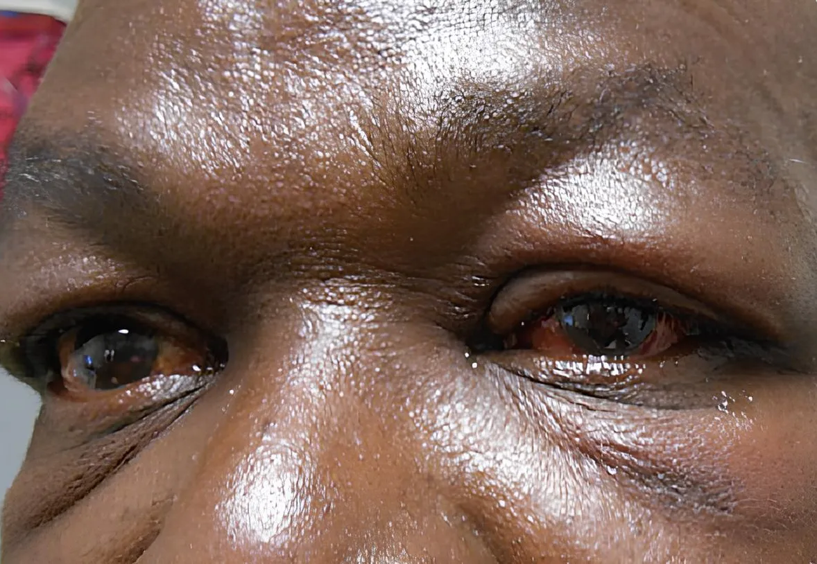 Aumento Alarmante de Casos de Conjuntivite Hemorrágica na Província de Maputo