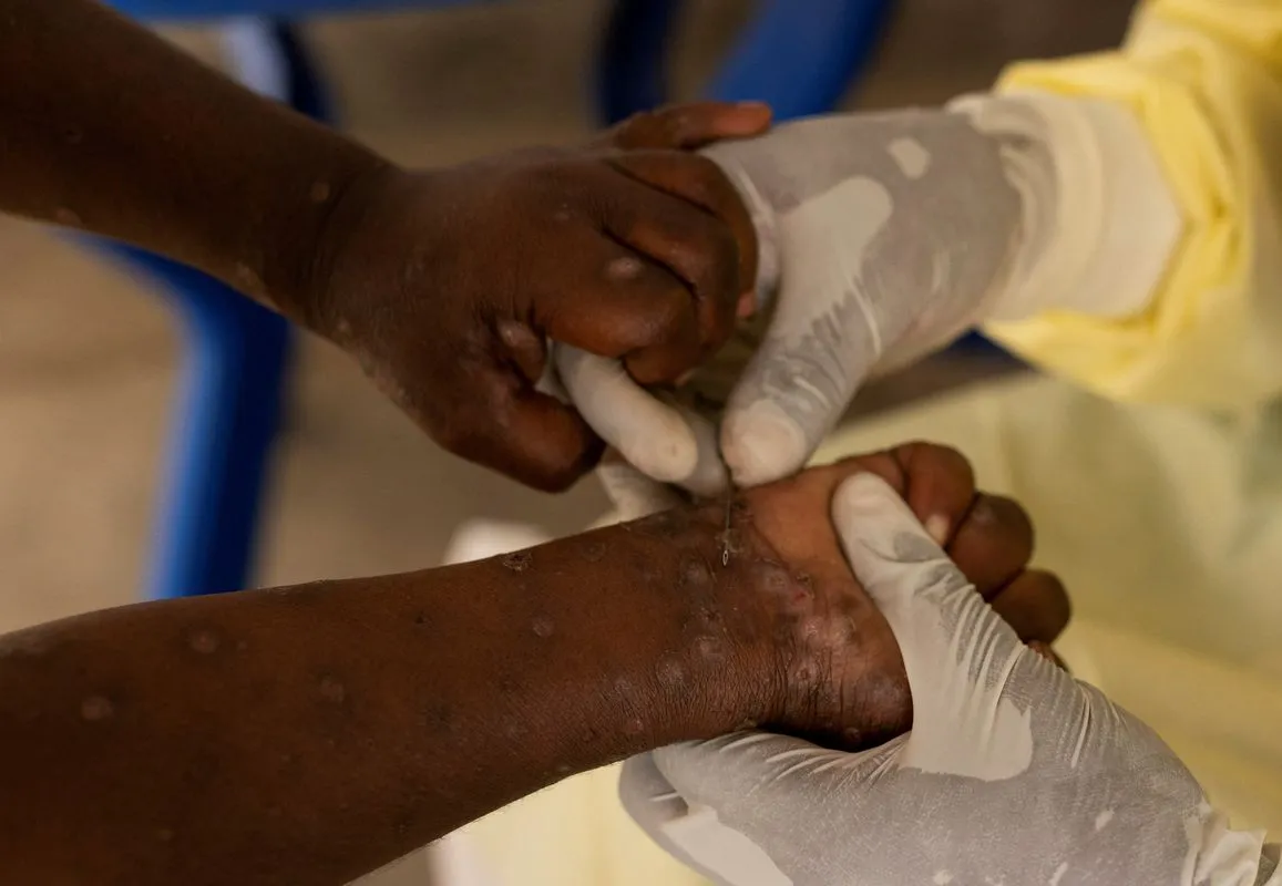 Moçambique Eleva Nível de Alerta Face à Nova Variante de Mpox