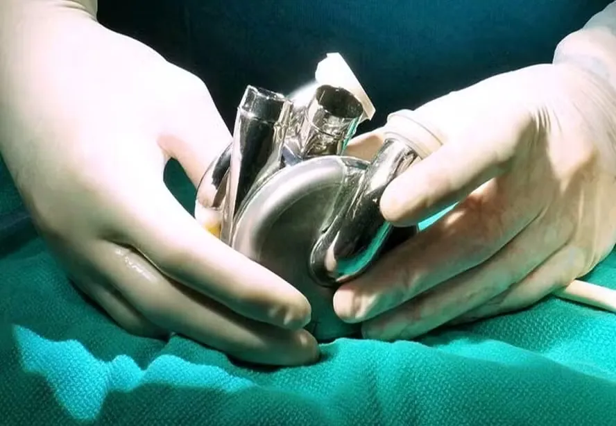 Cientistas implantam primeiro coração artificial de titânio em humano – um marco na medicina