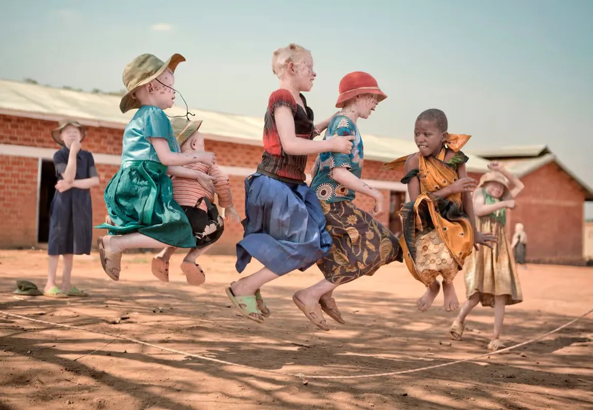Moçambique reforça compromisso com albinos perante discriminação e tráfico de órgãos